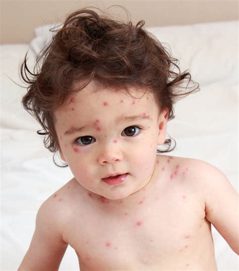 video despre varicele cu copilul
